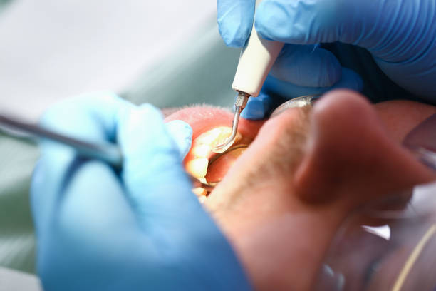 Best Knocked-Out Tooth (Avulsed Tooth) Treatment in Nanticoke, PA